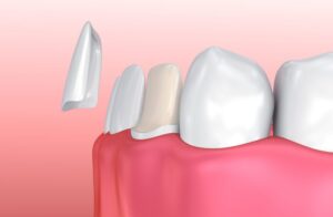 Veneers & Crowns